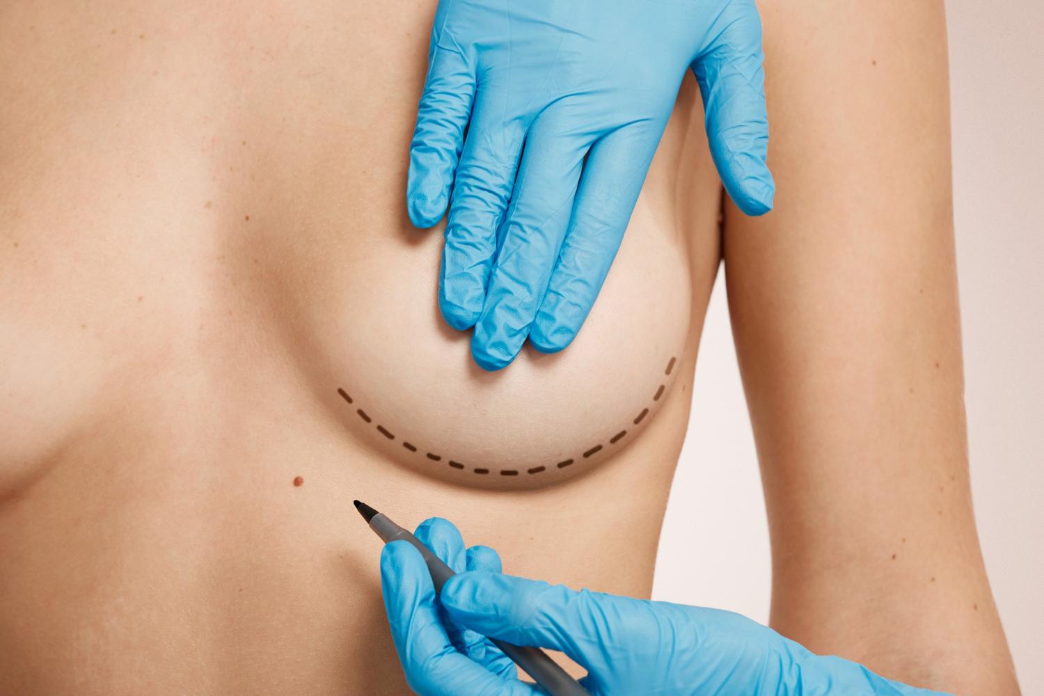 Muito além da vaidade: mamoplastia como forma de autocuidado